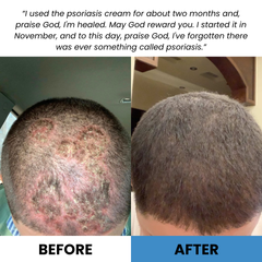 Coal Tar Psoriasis Repair Cream - Oran Skin