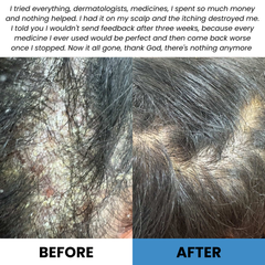 Coal Tar Psoriasis Repair Cream - Oran Skin